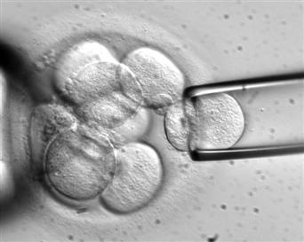 Pre-implantation Genetic Diagnosis of Blastomere